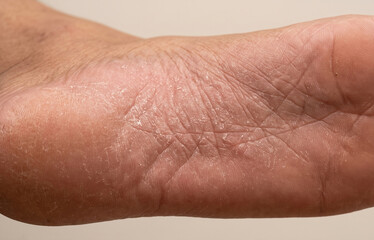 Fototapeta premium Close Up of Dry Peeling Skin and Fungal Infection on Sole of Foot
