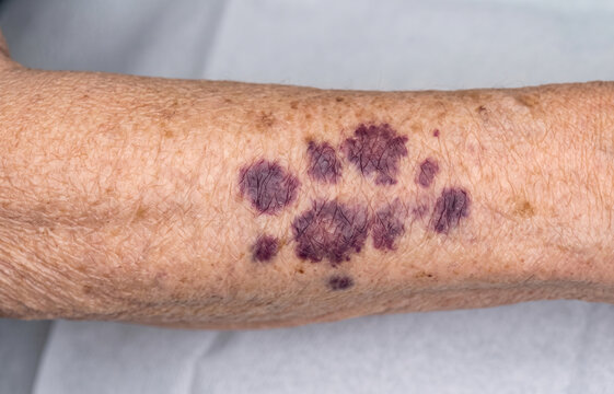 Close Up of Elderly Arm with Senile Purpura Dark Purple Bruising and Hematoma