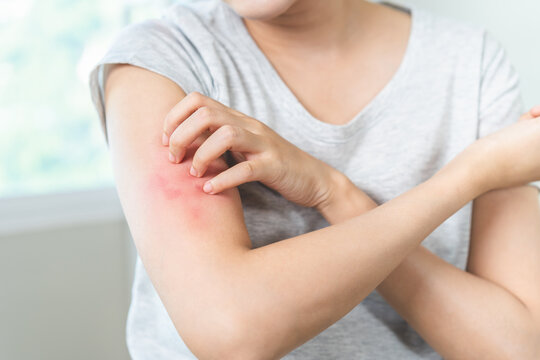 Dermatology asian young woman, girl allergy, allergic reaction from atopic, insect bites on arm, hand in scratching itchy, itch red spot or rash of skin. Healthcare, treatment of beauty concept.