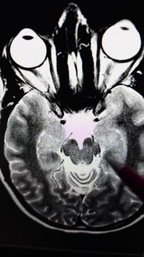 View of an axial T2-weighted brain MRI displayed on a screen, while a pen points toward the hippocampal region