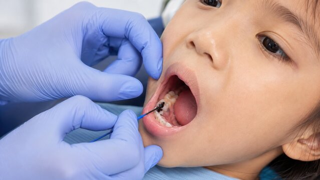 Dentist applying silver diamine fluoride to child's tooth cavity