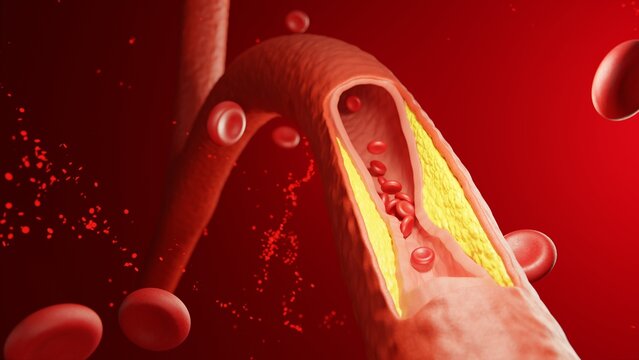 Atherosclerosis cross section showing cholesterol plaque build up inside blocked artery. 3D Render