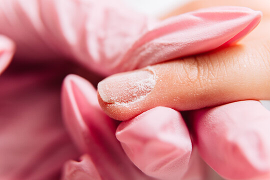 Macro of a finger with damaged nail covered in white dust held by hands in pink gloves showing nail care procedure in beauty salon for cosmetology themes