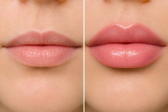 Before and after lip filler injection cosmetic procedure, hyaluronic acid lip augmentation volume results comparison