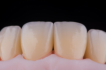 High-quality four dental crowns made of zirconium for fixation to the frontal teeth of upper jaw. © gorynvd