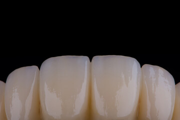 High-quality dental bridge made of zirconium for fixation to the teeth of upper jaw. © gorynvd