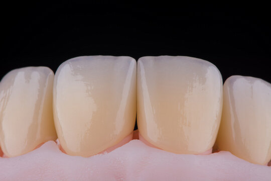 High-quality four dental crowns made of zirconium for fixation to the frontal teeth of upper jaw.