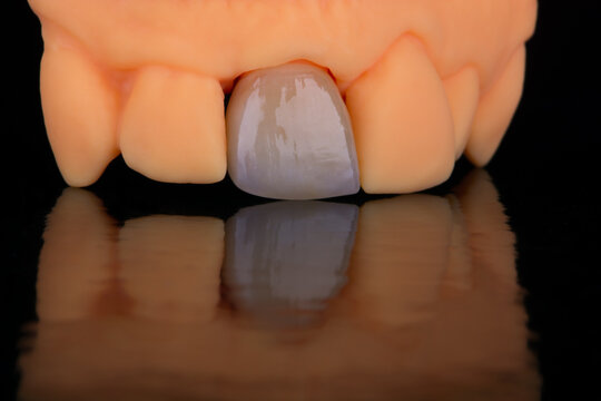 Mirror copy of central maxillary incisor, ultra thin dental ceramic veneer or crown on printed model
