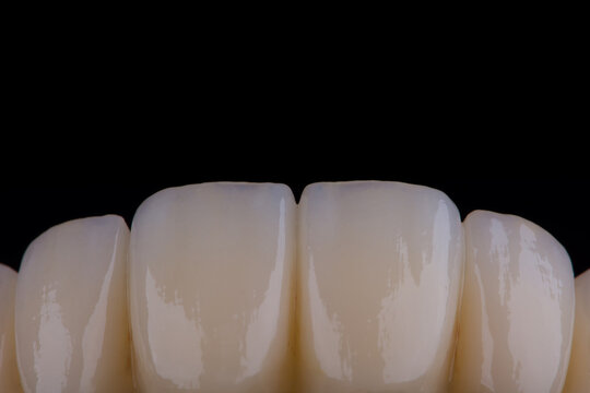 High-quality dental bridge made of zirconium for fixation to the teeth of upper jaw.
