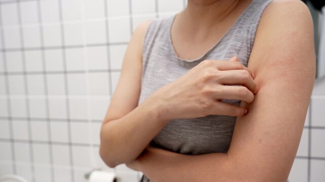 skin problem and beauty. Young woman scratch body has itchy skin from skin allergic, steroid allergy, sensitive skin, red from sunburn, chemical allergy, rash, insect bites, Seborrheic Dermatitis.
