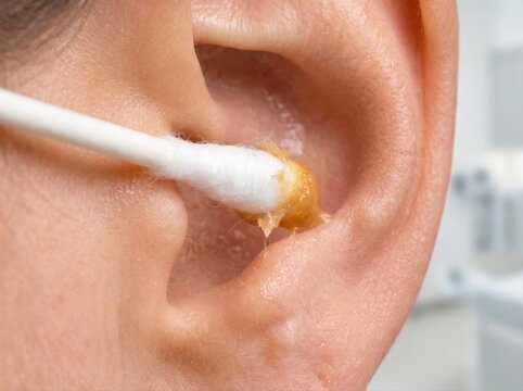 A close-up view of a cotton swab being used to remove earwax from the outer part of a human ear.