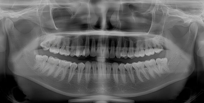 Full dental x-ray shows both upper and lower jaws