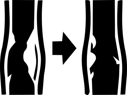 Artery plaque reduction medical icon showing blocked vessel clearing for International Day for Interventional Cardiology in minimalist vector style