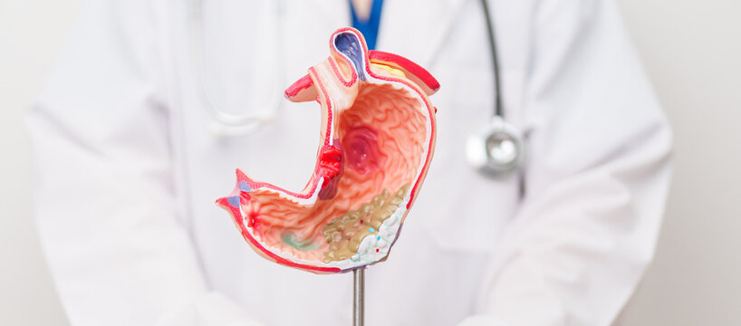 Doctor with Gastric anatomy model. Gastroenterologist consultation, stomach diseases and ulcers, November stomach cancer, Gastroesophageal Reflux Disease, GERD, Acid reflux and healthcare medical