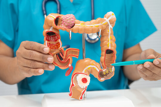 Colorectal cancer, doctor holding intestine colon human anatomy model.