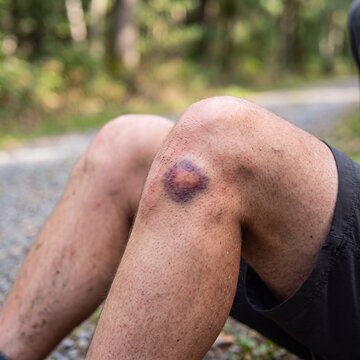 Fresh bruise on man's knee after fall on gravel path outdoors
