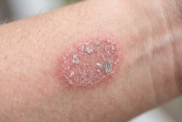 Fototapeta premium Psoriasis plaque on the elbow with red inflamed skin, silvery scales and dry flakes, showing a chronic dermatological condition in a detailed medical close-up.