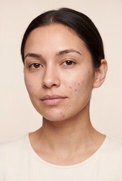 Closeup of woman with acne and blemishes showing skin condition for dermatology background and skincare treatment awareness