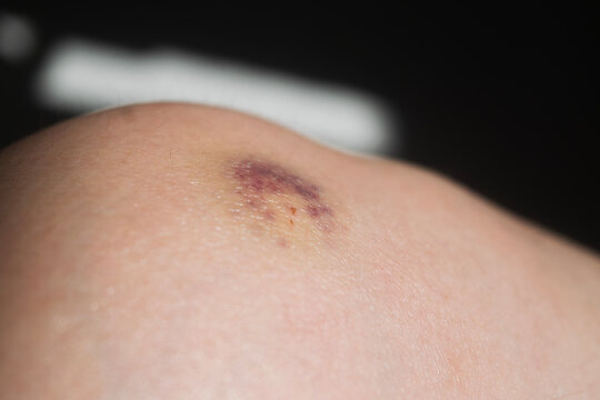 Bruised Knee Skin Showing Visible Contusion