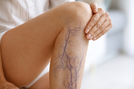 Female patient showing varicose veins on leg during medical phlebologist consultation. Close-up vascular disease symptom, phlebology surgery. Doctor checks health. Human vessel, arteries. Blood system