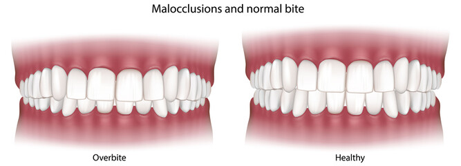 Overbite and Healthy Bite Comparison, Dental Malocclusion Medical Illustration. Overbite Malocclusion Compared with Normal Dental Occlusion. Orthodontic Dental Anatomy Illustration © sakurra