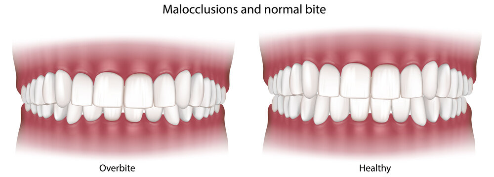 Overbite and Healthy Bite Comparison, Dental Malocclusion Medical Illustration. Overbite Malocclusion Compared with Normal Dental Occlusion. Orthodontic Dental Anatomy Illustration