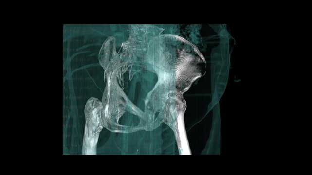 Translucent Cyan Pelvic Structure and Femoral Head CT Scan
