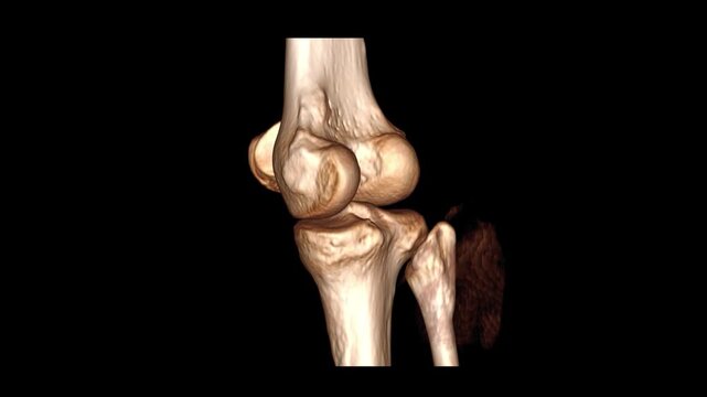 Isolated Human Knee Joint Skeleton CT Scan