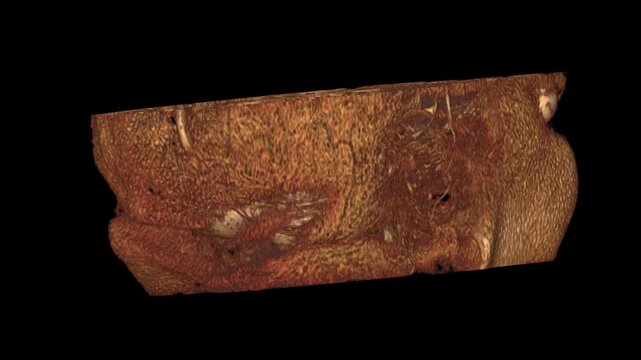 3D CT Scan Rotating View of Facial Bones Eyes and Cranial Cavity