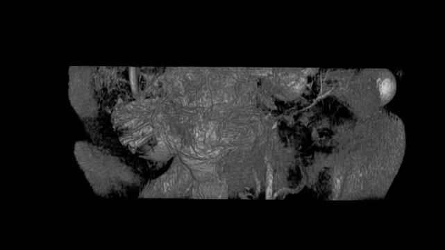 Rotating 3D CT Scan View of Craniofacial Anatomy and Ocular Orbits