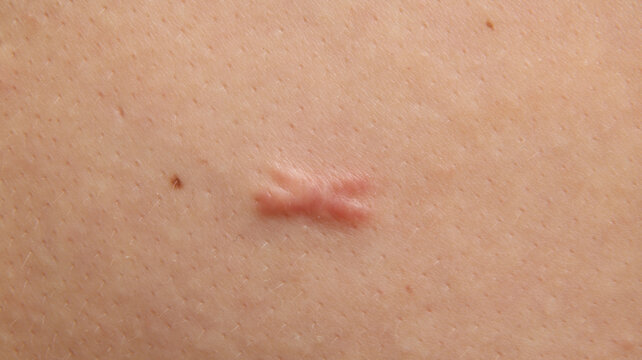 a raised and pinkish scar possibly a hypertrophic