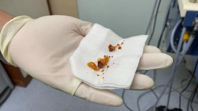 Large amount of ear wax on gauze removed by medical doctor in ENT otolaryngology hospital clinic. Closeup of cleaned out dirty dark brown impacted cerumen, hygiene & ear cleaning
