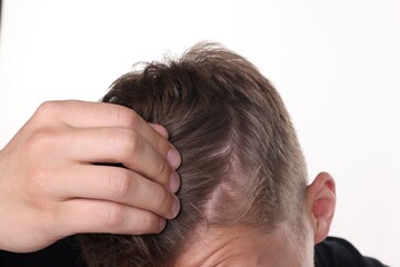 Fototapeta premium Man examining his head on white background, closeup
