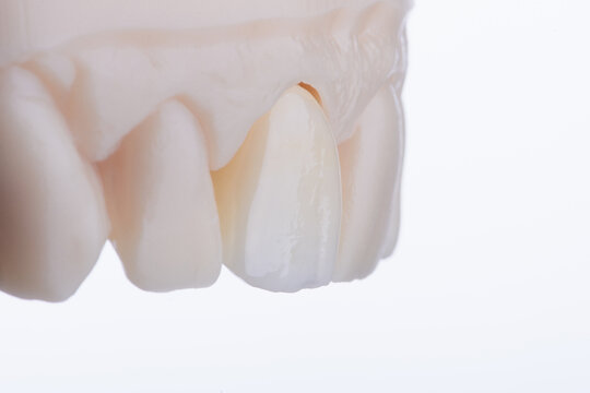 Mirror copy of central maxillary incisor, ultra thin dental ceramic veneer or crown on printed model