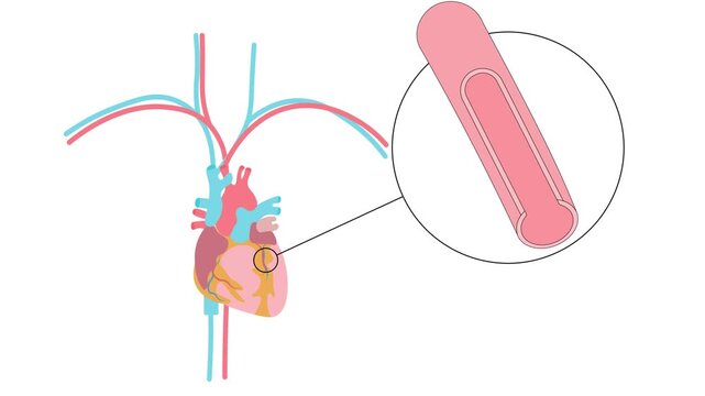 Medical vector animation illustrating angina with a narrowed coronary artery and reduced blood flow to the heart muscle, highlighting myocardial ischemia and related cardiovascular ,atherosclerosis