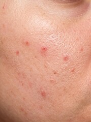 Fototapeta premium Detailed macro potrait of human facial skin texture with visible red acne for dermatological research, skincare marketing, and medical education.