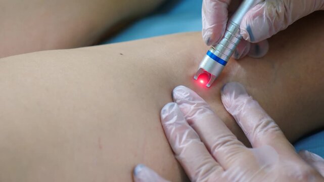 Gloved hand holding silver laser device with red beam treating woman leg veins. Professional aesthetic vascular removal procedure for safe coagulation therapy in modern cosmetology clinic 4k video