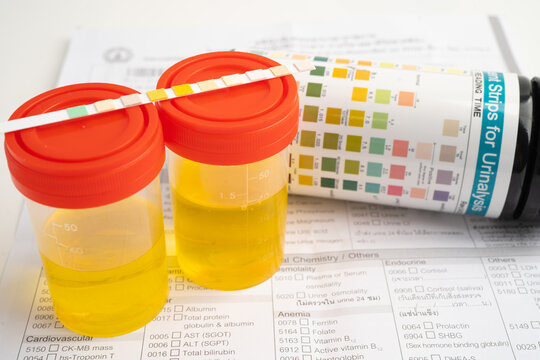 Urinalysis, urine cup with reagent strip pH paper test and comparison chart in laboratory.
