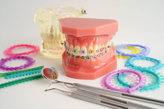 Orthodontic ligatures rings and ties, elastic rubber bands on orthodontic braces, model for dentist studying about dentistry.