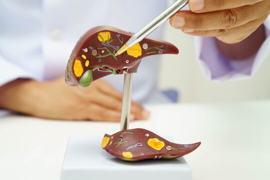 Cirrhosis, Liver cancer, fatty liver, Asian doctor with liver human anatomy model in World Hepatitis Day at hospital.