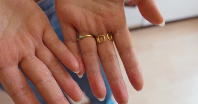 Close-up of extremely dry hands with peeling skin caused by dehydration, irritation, or damaged skin barrier.