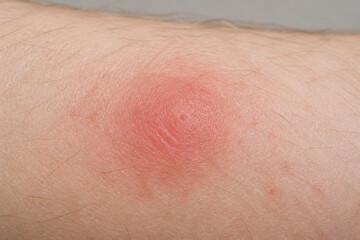 Fototapeta premium Red swollen mosquito bite on forearm skin, insect bite irritation and allergy