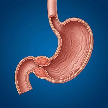 stomach illustrating pyloric stenosis. The pyloric sphincter is visibly narrowed and thickened, restricting the passage of food to the duodenum. The stomach body above the stenosis appears slightly en