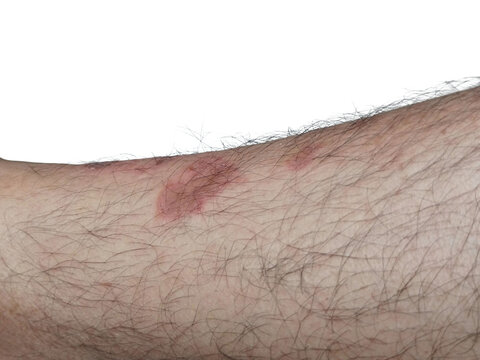 Skin fungus ringworm lesion on male leg isolated