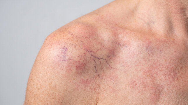 Spider Veins on Sun Damaged Shoulder Skin Close Up