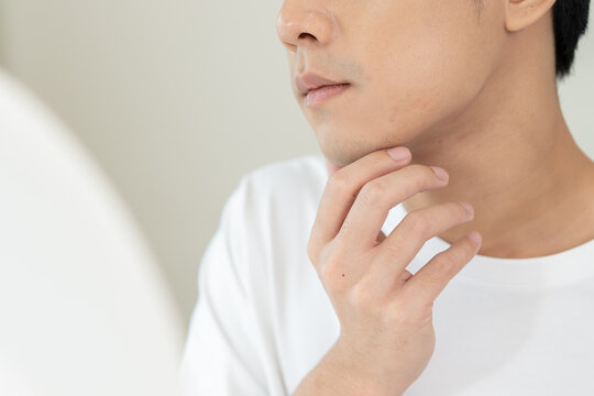 Asian men worry about acne on their faces when looking in the mirror