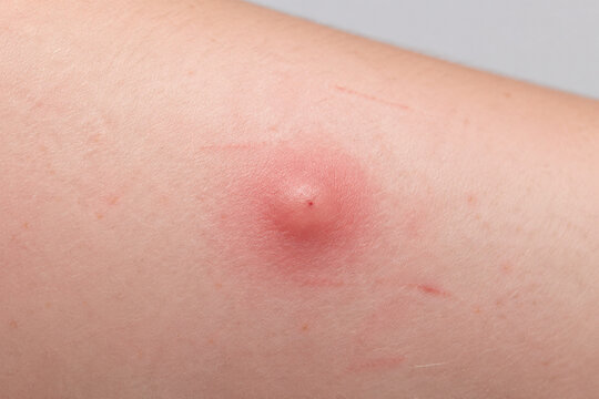 Red swollen mosquito bite on forearm skin, insect bite irritation and allergy