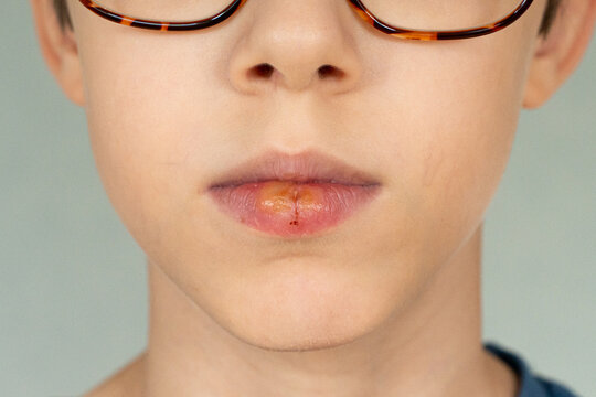 Close up frontal Herpes simplex virus type 1 HSV-1 on the lips