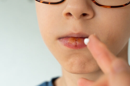 Close up application of an antiviral ointment to the herpes simplex virus type 1 lesion