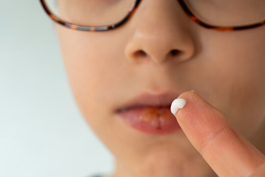 Close up application of an antiviral ointment to the herpes simplex virus type 1 HSV-1 lesion